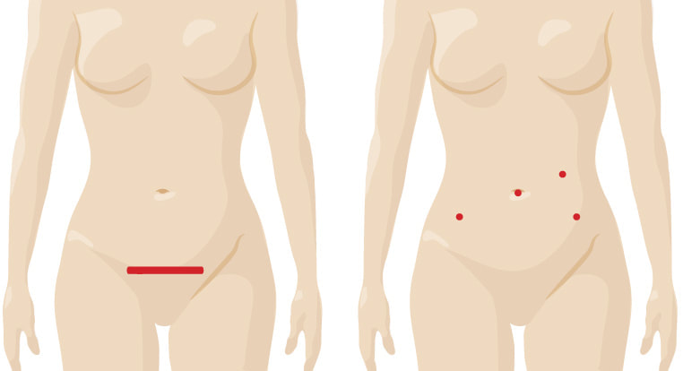 Diagram showing typical robotic surgery incision sites