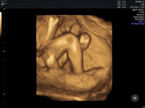 3D ultrasound image