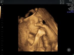 3D ultrasound image